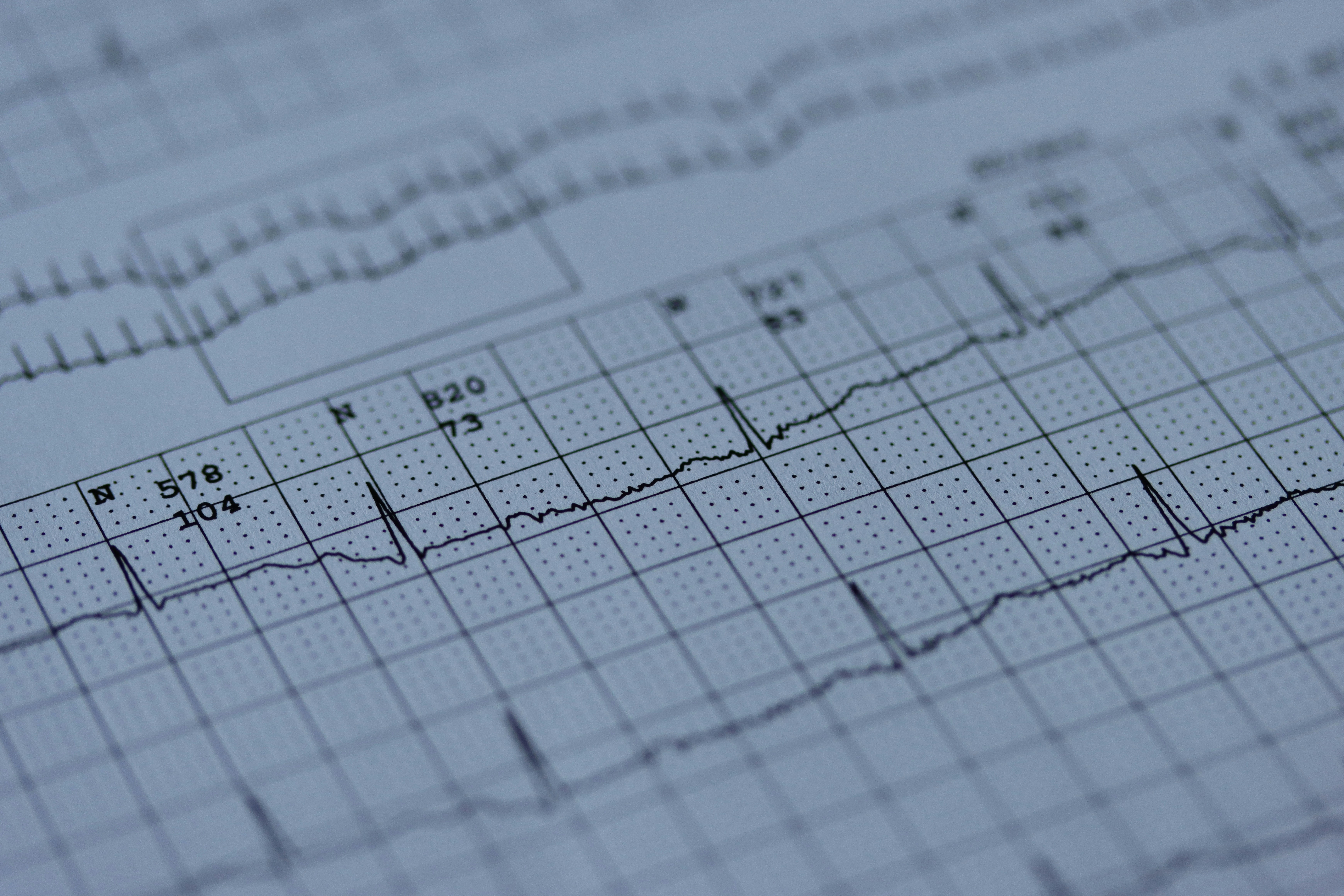 ECG & TMT (Stress Test)